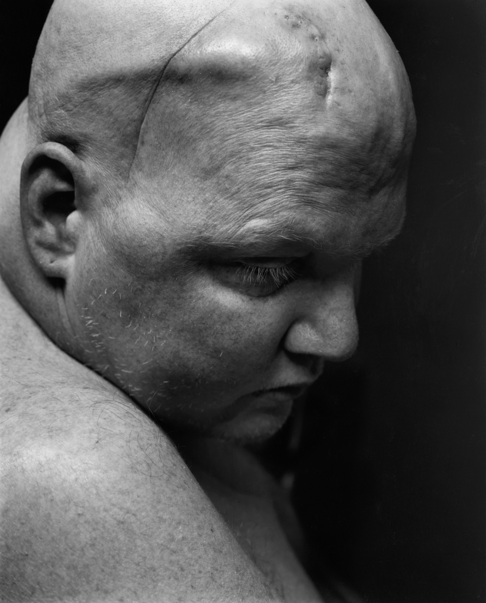 Nicholas Nixon: Patients | Fraenkel Gallery