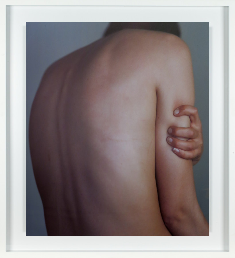 Color photograph of a person's bare back with their hand clutching their upper arm